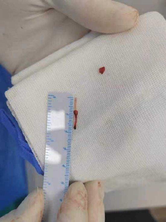留置针软管遗留患儿体内5年后终被取出