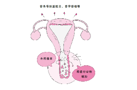 阴道炎对备孕都有哪些影响？