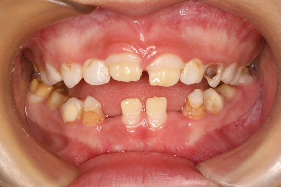 牙釉质发育缺陷性疾病（Developmental defects of enamel， DDE）