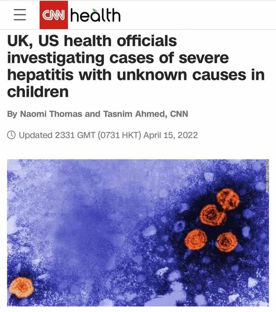 英国率先报告数十例儿童不明原因急性肝炎后多国陆续出现